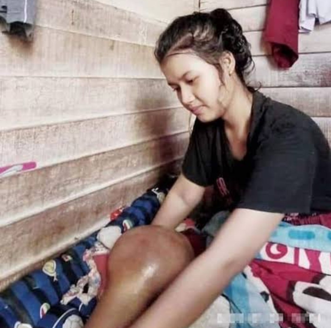 Ketegaran Riska Ramadila, Siswi Cantik Idap Tumor Berharap Sembuh Tanpa Amputasi Kakinya