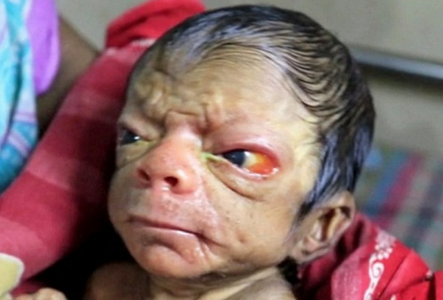 Meski baru dilahirkan, wajah bayi ini tak lazim seperti bayi. Wajah bayi malang ini keriput dan mirip manusia lanjut usia *(manula) berusia 80 tahun.
